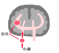 脳塞栓