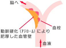 頚動脈狭窄症