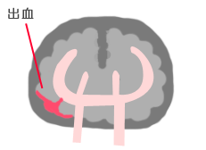 くも膜下出血
