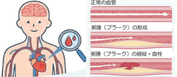 心血管ドック